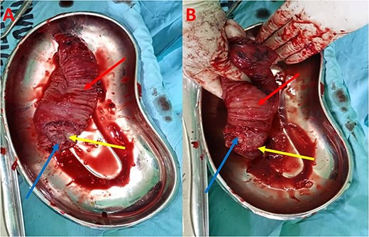 (A) Gross specimen demonstrating intussusception with rectal tumor; (B) Gross specimen demonstrating reduction of the intussusception; red arrow—intussuscipiens; blue arrow—intussusceptum; yellow arrow—rectal tumor.