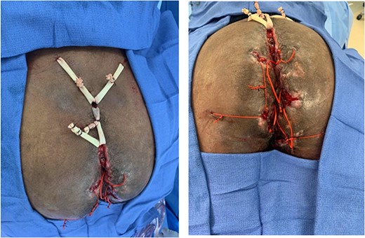 Multiple noncutting setons placed to treat extensive complex and severe trans-sphincteric, supra-sphincteric and extra-sphincteric fistulizing perianal CD featuring multiple external openings, atypical locations and associated perianal abscesses.