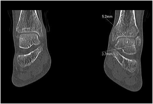 CT right ankle, arrow osteochondral lesion of the talus.