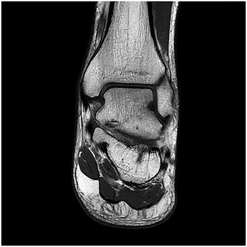 MRI ankle.