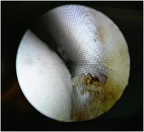 Arthroscopy view.