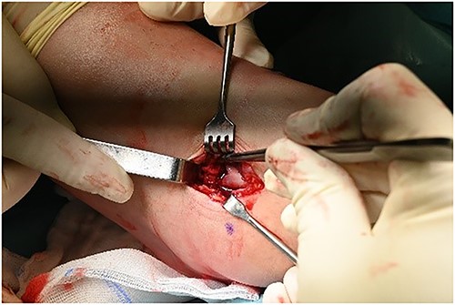 Mini open artrotomy.