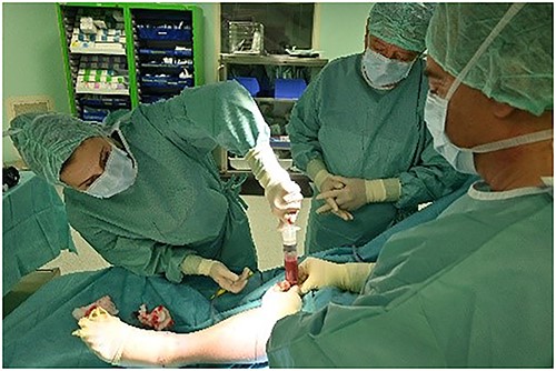Bone marrow aspirate from proximal tibia.