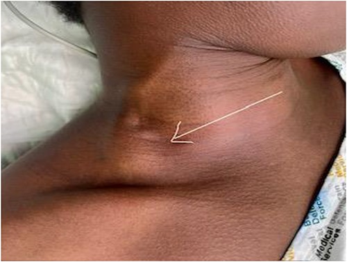 Right-sided neck mass (arrow) that is soft, compressible, non-tender, non-pulsatile, measuring 4 cm × 4 cm and present in the posterior triangle of the neck in the supraclavicular region.