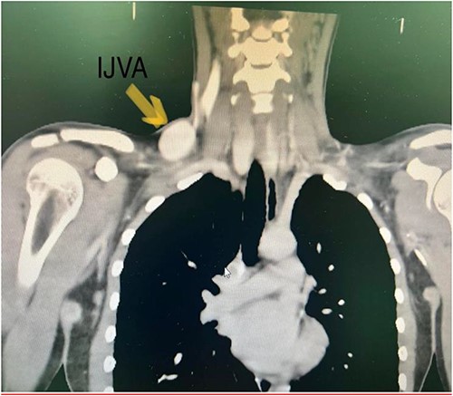 CT with IV contrast showing IJV aneurysm. CT with intravenous contrast showed aneurysmal fusiform venous tributary in right-sided lower neck that originate from right IJV and rejoins IJV before its insertion with the right subclavian vein to form the innominate vein measuring 6 cm in length and 4 cm in maximum diameter. There was no compressing mass in the chest or neck. SVC was normal with no signs of stenosis or compression.