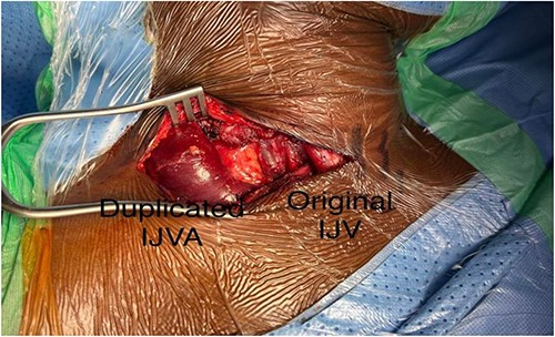 After dissection and identification of duplicated internal jugular vein aneurysm and the original IJV.