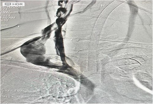 An intraoperative venogram was done through IJV; duplication with an aneurysmal limb is shown.