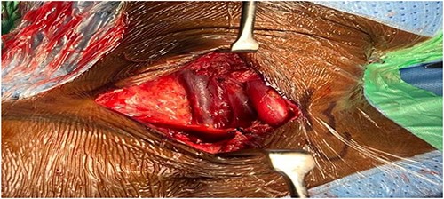 After complete transection of the aneurysm was done.