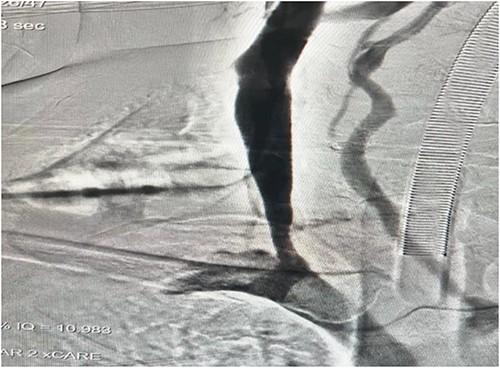 A completion venogram confirmed successful excision of duplicated IJVA.