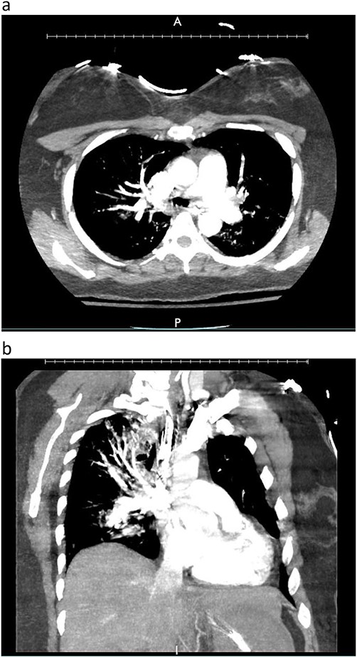 Donor angio CT scan: (a) filling in the left PA, (b) reduction of blood supply of the left lung.