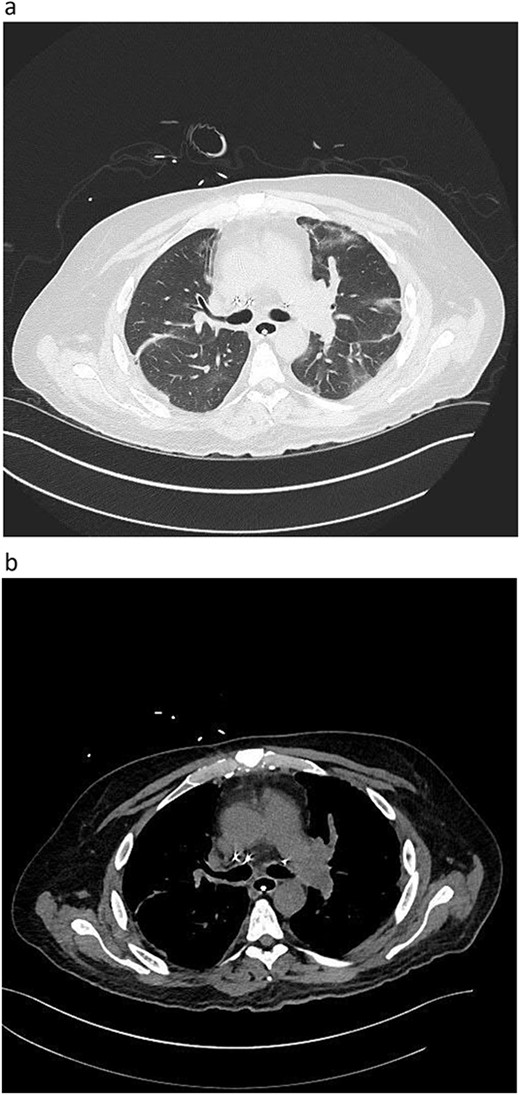 Postoperative graft CT scan: recipients had bilateral lung reduction due to over size.