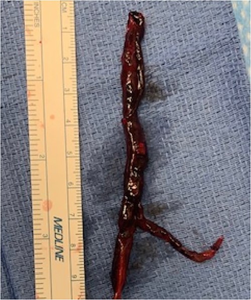 Extracted LPA thrombus.