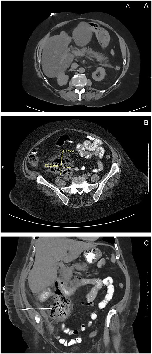 (A) ED CT scan demonstrating fat stranding around the pancreas. (B) Large fluid collection in the retroperitoneum. (C) Oral contrast noted in the IR drain. Large fluid collection in the retroperitoneum consistent with duodenal perforation.