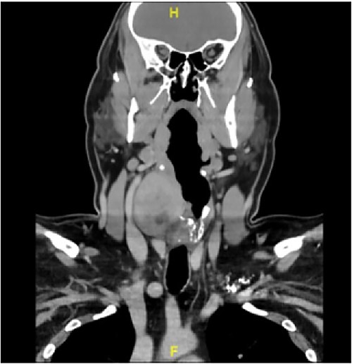 CT scan illustrating the large 6.5 cm mass involving the right larynx and hypopharynx.