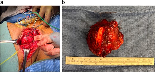 Gross images of the LMS in the operating room (a) and post-excision with clear illustration of the involvement of the thyroid cartilage (b).