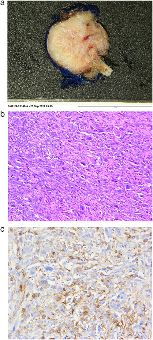 Histopathological analysis of the LMS including the gross image (a), hematoxylin and eosin staining (b), alpha smooth muscle actin immunohistochemical staining (c).