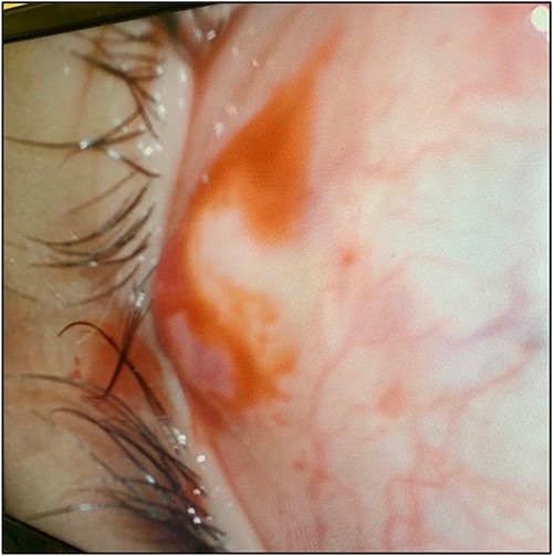 Picture showing the subconjunctival mass with overlying dilated vessels.