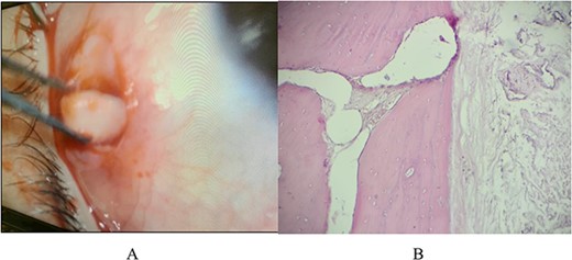 (A) Picture showing the gross anatomy of this white osseus lesion during removal from the subconjunctival space; (B) histologically the lesion was composed of mature lamellated bone with Haversian system and may be surrounded by thin connective tissues capsule, rarely some may have bony trabeculae with marrow elements.