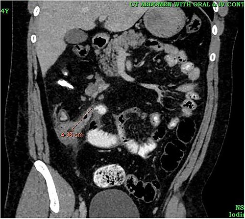 CT image showing inflammed stump appendix.