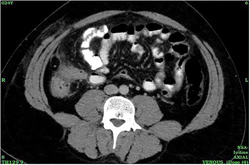 CT abdomen showing caecal wall thickening.