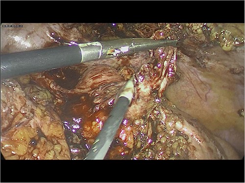 Intra-operative image of appendicular stump.