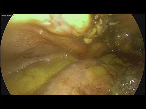 Intra-operative image of peritoneal nodules.
