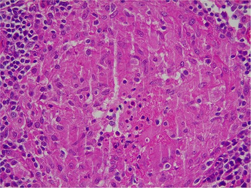 Microscopic image of caseous necrosis.