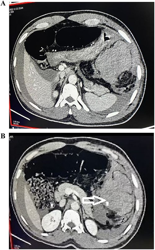 (A, B) CT abdomen and pelvis with IV contrast demonstrating hyperdense area of blood density suggestive of hematoma with eccentric focal intrinsic extravasation of contrast at left hypochondrium.