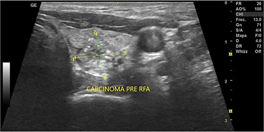 Thyroid ultrasound: transversal view, left lobe nodule identification and measures. Pre-RFA procedure.