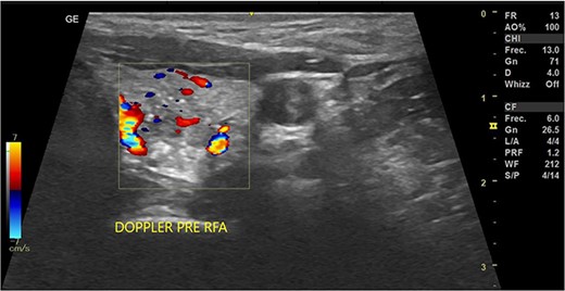 Doppler thyroid ultrasound: transversal view, left lobe nodule doppler. Pre-RFA procedure.