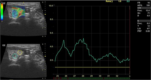Thyroid ultrasound: elastography, Left lobe and nodule. Pre-RFA procedure.