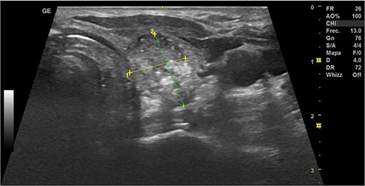 Thyroid ultrasound: left lobe, transverse view, nodule identification and measures. The first-month follow-up.