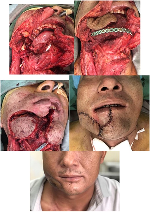 Case no. 6. (A) Intraoperative photograph of a 48-year-old man demonstrating tumor of lower–alveolar ridge invasing through the right cheek skin. Biopsy revealed the mass to be a squamous cell carcinoma. (B) The defect involved the right buccal mucosa, the mouth floor, the right mandible from the midline to the angle area and the external face skin. (C–D) Total reconstruction of all defect components was achieved with a left fibula osteoseptocutaneous flap and a left anterolateral thigh fasciocutaneous flap and (E) 6 months post-reconstruction.