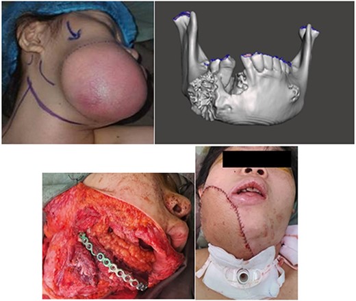 Case no. 3. (A) Preoperative photograph of a 18-year-old woman demonstrating tumor eroding through the right cheek skin. (B) CT image showing a tumor of the right mandibular bone. Biopsy revealed the mass to be a osteosarcoma. (C) Intraoperative photograph showing fibular osteocutaneous free flap used for the reconstruction of the mandibular defect as well as to provide lining for the intraoral defect. (D) The anterolateral thigh musculocutaneous free flap is used to cover the exposed fibular free flap and the external cheek defect.
