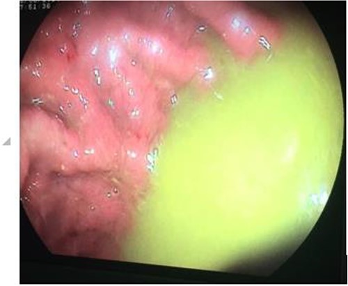 Upper endoscopy showing gastric stasis and fecal liquid in gastric cavity.