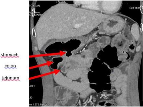 Coronal section showing the parietal defect of the greater curvature of the stomach communicating with the colon.