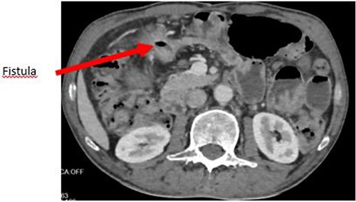 Axial section showing the large GJF with stranding of the surrounding fat.