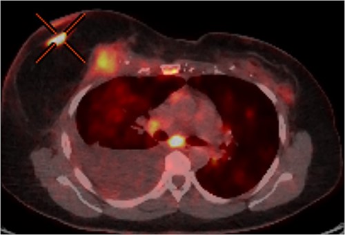 PET-CT axial slice showing both superficial and deep components of the local recurrence with associated malignant pleural effusion from direct extension to the pleural cavity.
