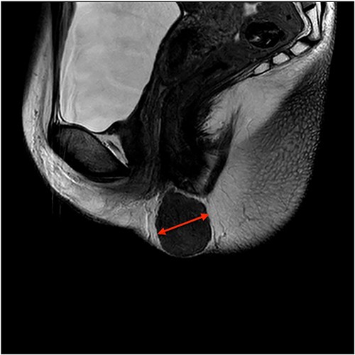 Coronal view MRI image of the lesion marked with a red arrow.