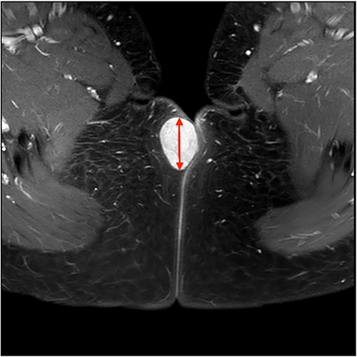 Axial view MRI image of the lesion marked with a red arrow.