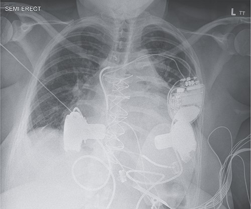 Anterior–posterior chest X-ray following BiVAD implantation.