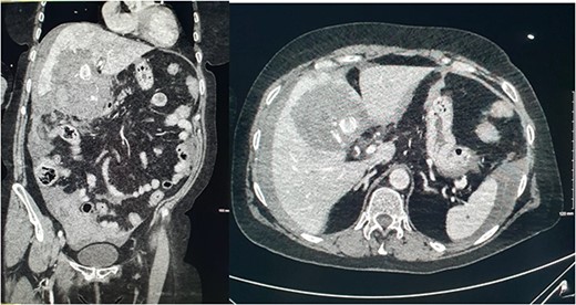 CT abdomen and pelvis with intravenous contrast in the portal venous phase was performed demonstrating perforated acute calculous cholecystitis and active haemorrhage.