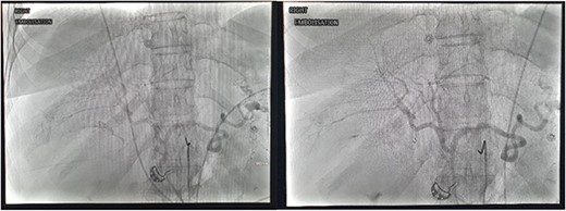 DSA images demonstrating active haemorrhage from the cystic artery and subsequent coil embolization with cessation haemorrhage.