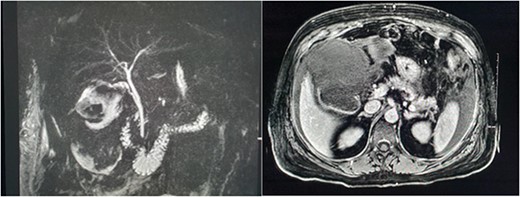 MRCP and post contrast MRI images demonstrating the wide mouthed frank disruption of gallbladder wall.