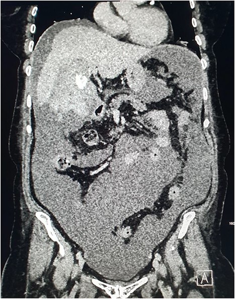 CT demonstrating large volume of bilious peritoneal fluid with haematoma and calculus in the gallbladder fossa.