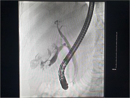 Fluoroscopic ERCP image demonstrating gallbladder perforation.