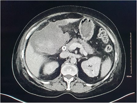 CT demonstrating superinfection of the gallbladder fossa haematoma and abscess formation.