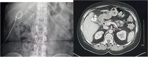 Radiographic and CT images demonstrating the patients’ hardware at discharge with an endoscopic biliary stent and gallbladder fossa pigtail drain in situ.