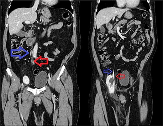 Sequential coronal CT with IV contrast. Left image showing renal artery (red) and vein (blue) arising from abdominal aorta and IVC. Right image showing descending vessels going into the incarcerated right kidney.