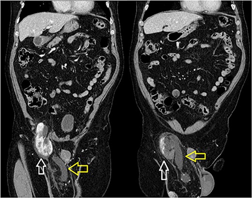 Incarcerated right kidney (white) in the inguinal hernia with distended ureter within the hernia sac (yellow).